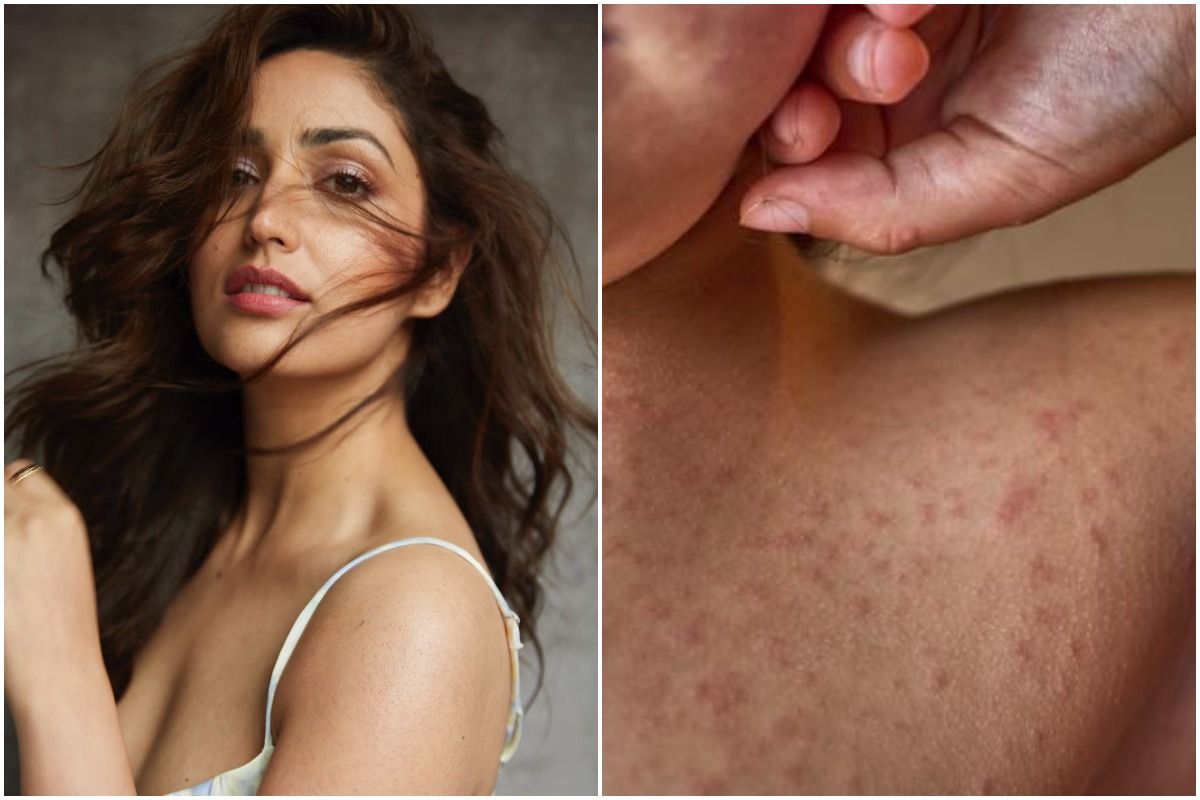 What Is Keratosis Pilaris The Skin Condition That Yami Gautam Is Suffering From