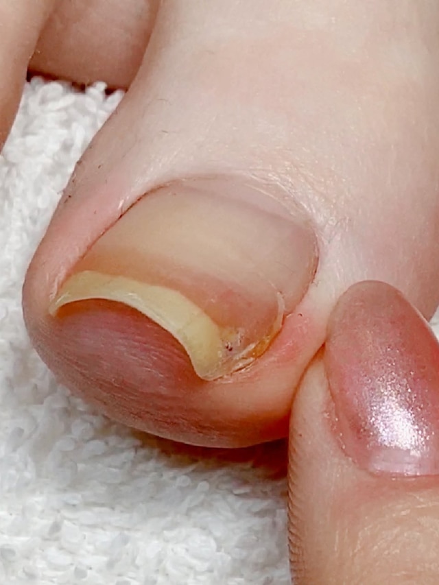 Ways To Treat A Painful Ingrown Toenail At Home