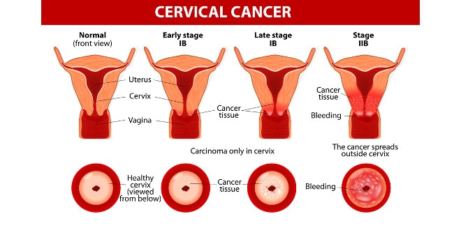 Important Facts About Cervical Cancer India Com