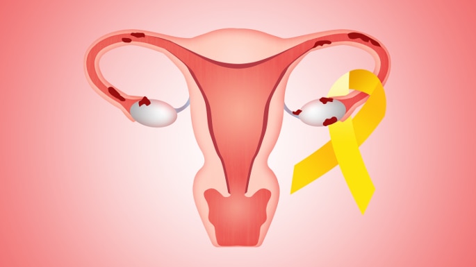March is Endometriosis awareness month. If the average time to diagnosis  (7-10 yrs) is anything to go by, we need a whole lot more then a…
