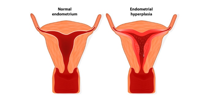 March is Endometriosis awareness month. If the average time to diagnosis  (7-10 yrs) is anything to go by, we need a whole lot more then a…