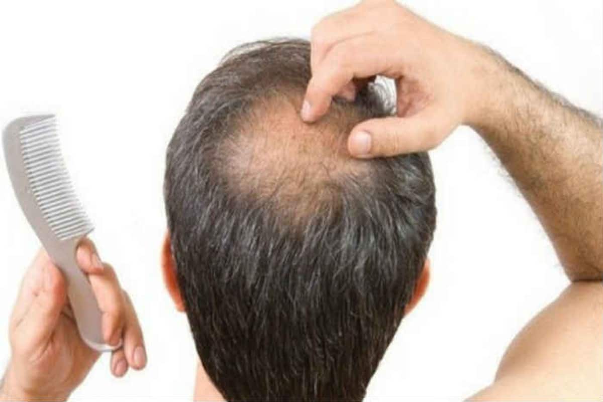 Grow Hair on Bald Head With This New Wearable Device, Read on 