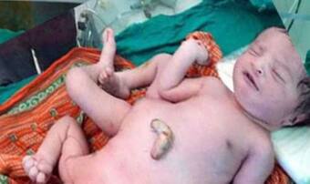Bizarre! Bihar woman gives birth to conjoined boy and girl with 6 limbs and  2 heads (See Pic) 
