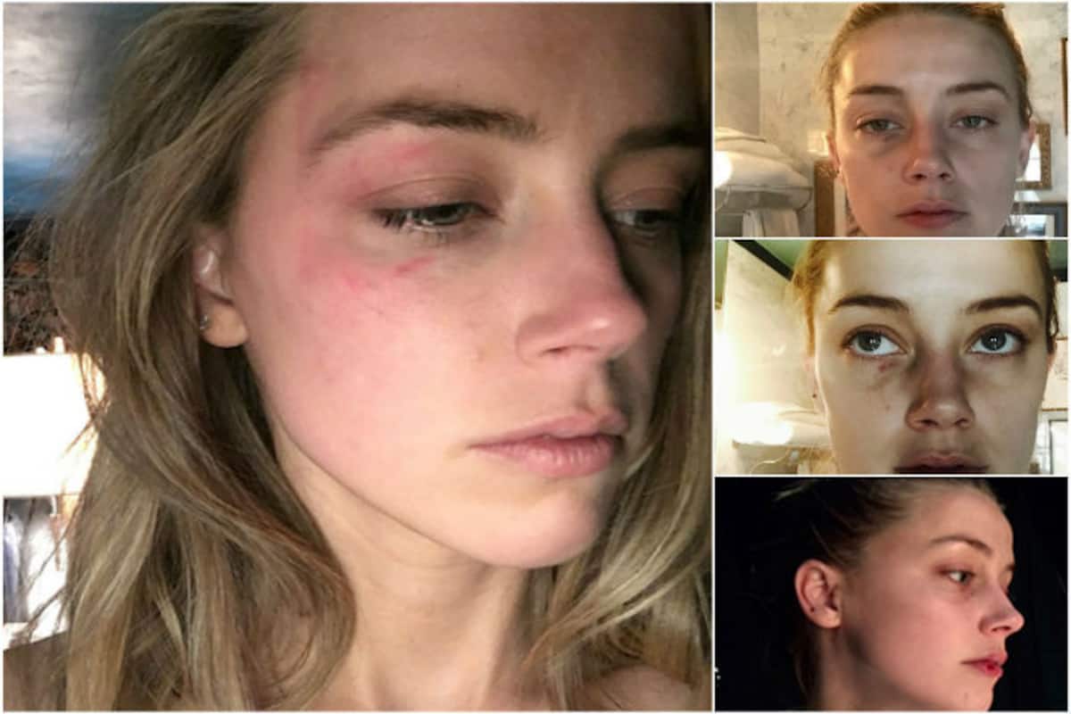 Amber Heard releases new photos of alleged domestic abuse by Johnny Depp |  India.com
