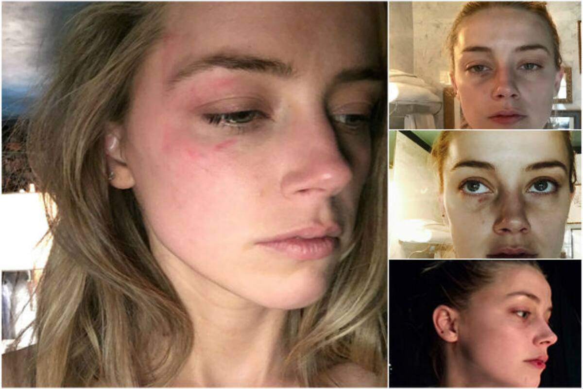 Amber Heard releases new photos of alleged domestic abuse by Johnny Depp |  India.com