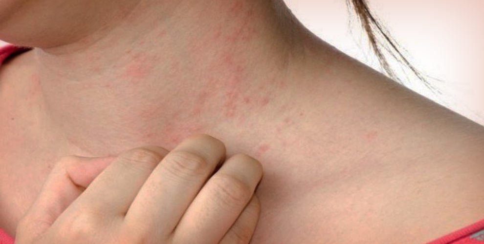 ek_skin-allergy