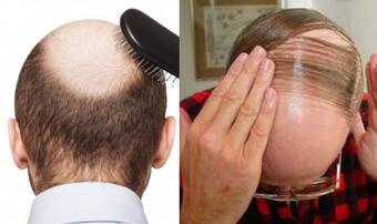 South Korean Scientists Claim to Have Found Cure For Baldness: Report |  