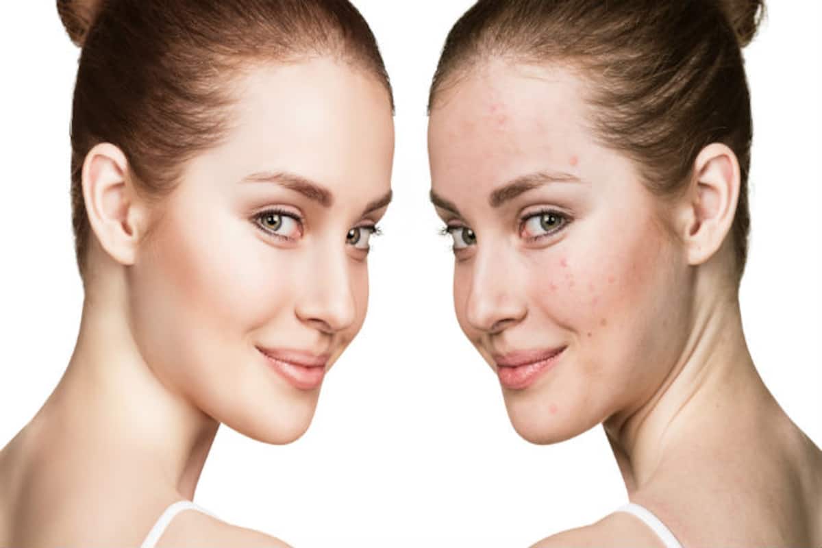 How to get rid of acne? 19 tips to get back your acne-free glowing and healthy  skin 