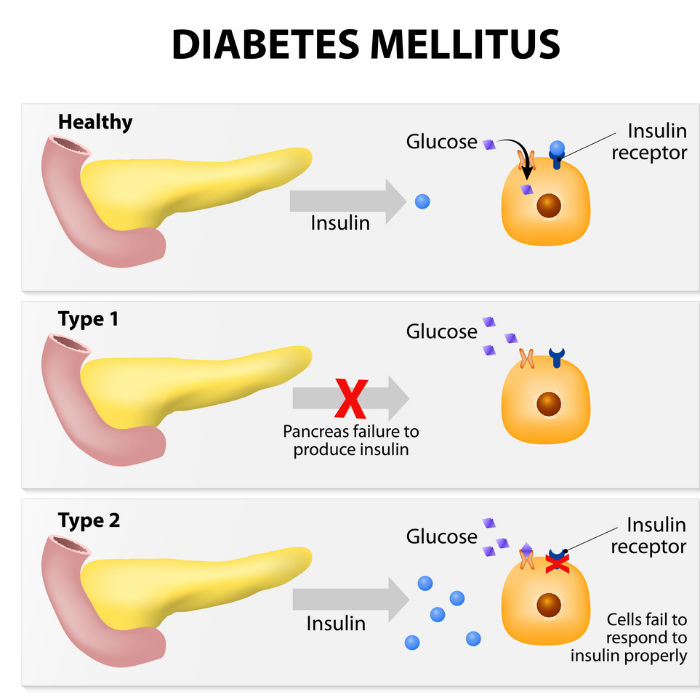 diabetes 3