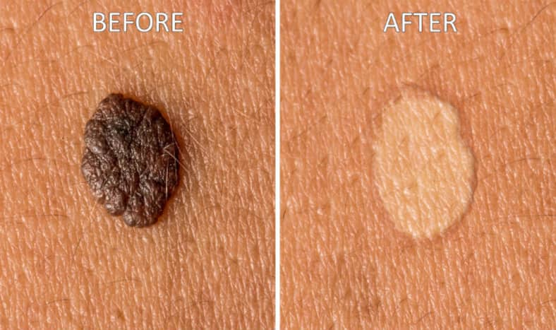 How to get rid of moles: 9 natural home remedies to remove moles from your body