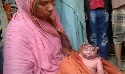 Newborn Believed To Be Lord Hanuman Incarnation In Bihar Village Actually Suffers From Rare Genetic Disorder India Com