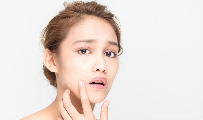 Keep acne and rashes at bay with mustard oil