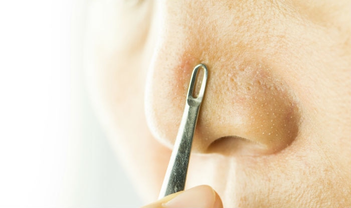 Top 9 frequently asked questions about blackheads, answered!