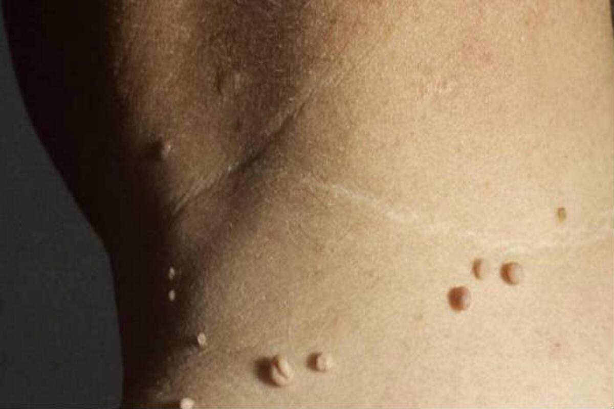 Home Remedies For Warts: चंद दिनों में मस्सों को जड़ से करना है गायब तो आजमाएं ये घरेलू तरीके, हफ्तेभर में हो जाएंगे गायब