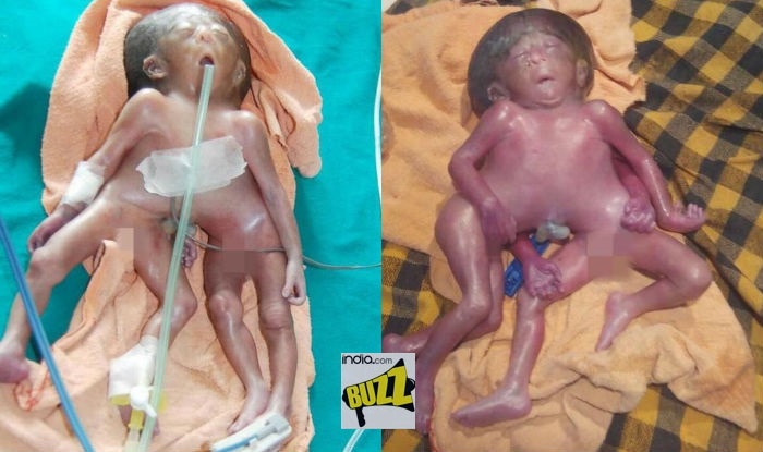 Baby girl born with two torsos, four arms and four legs in India! Watch video of deformed newborn from Bihar who is no more