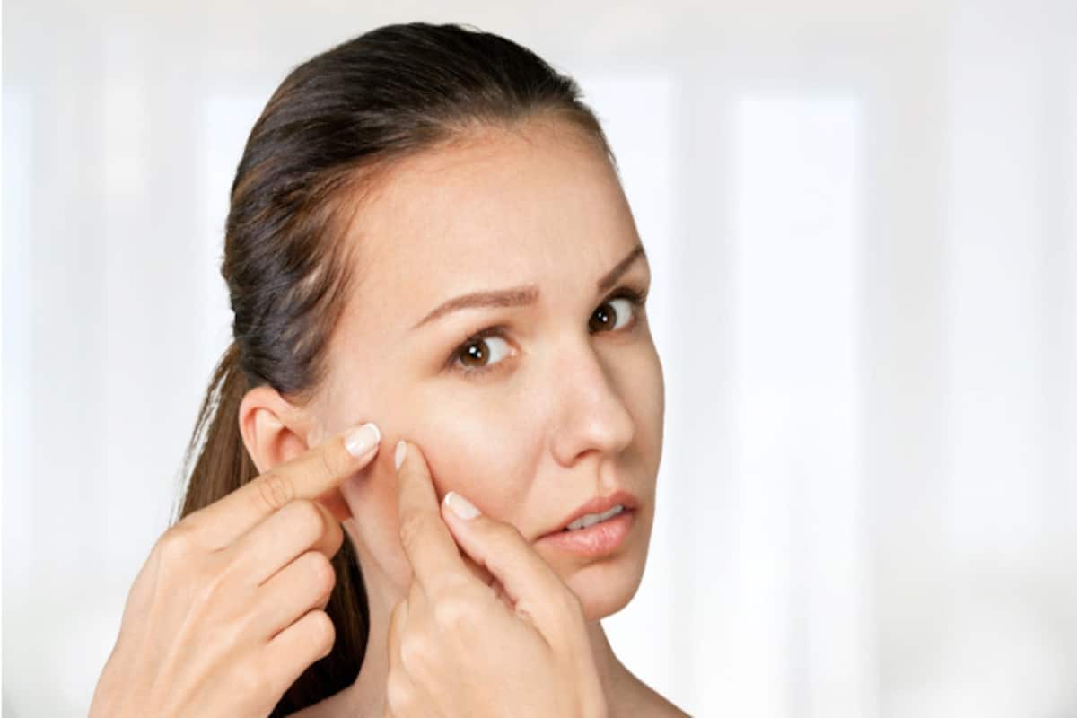How to get rid of pimples easy overnight