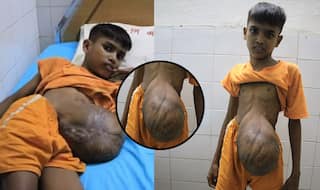 Bangladeshi Boy Struggles With Football Sized Hernia Dangling From his Stomach; Fighting This Illness Since Birth!