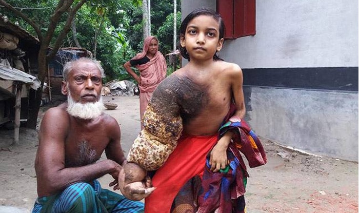 Tree Man' Disease is Making This Bangladeshi Girl's Chest and Hand