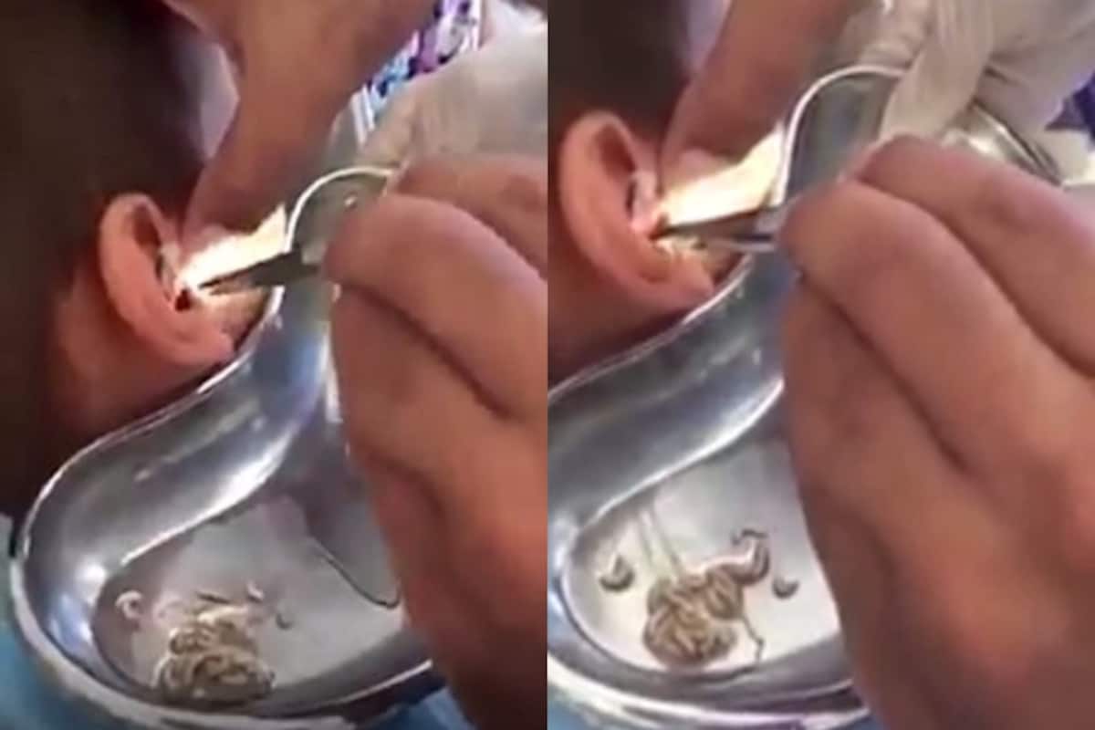 Doctor Removes Dozens of Live Maggots From Kazakhstan Boy's Ears, Video  Goes Viral
