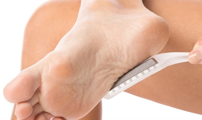 Soften hard calluses