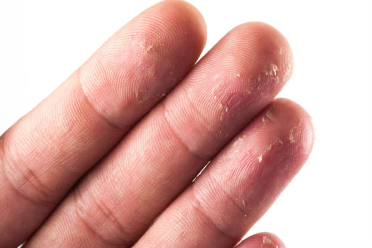 Fingertips Peeling : 5 Tips to Get Rid Peeling Skin from | India.com