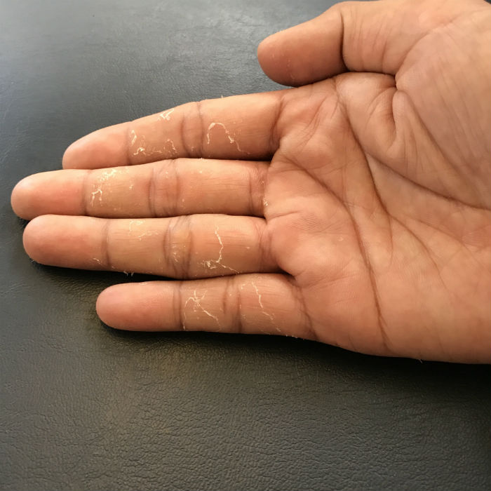 My finger skin peels like this all the time. Why does it happen, and how  can I prevent it? : r/peeling