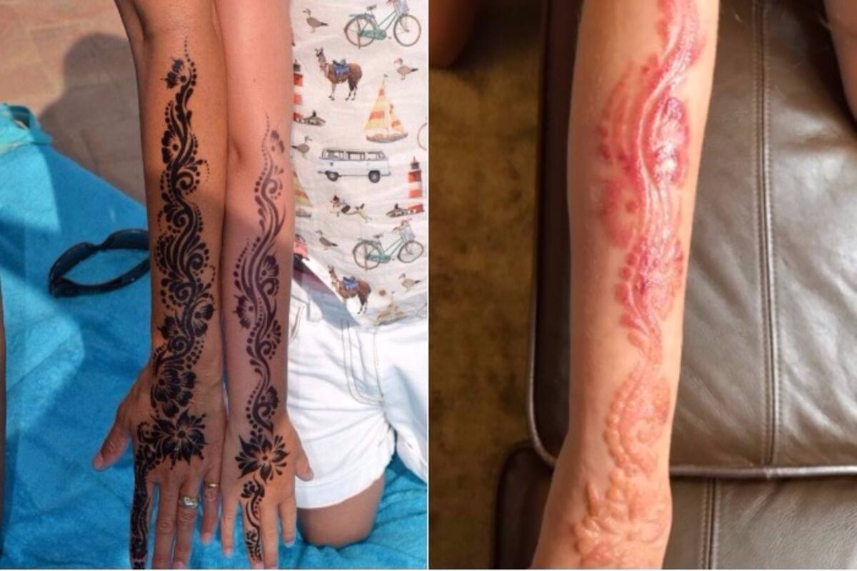 Girl Suffers Chemical Burns From Black Henna Tattoo Pictures Show 7 Year Old Crying In Pain India Com