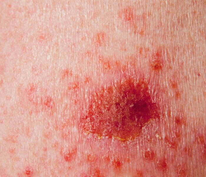 skin cancer 2