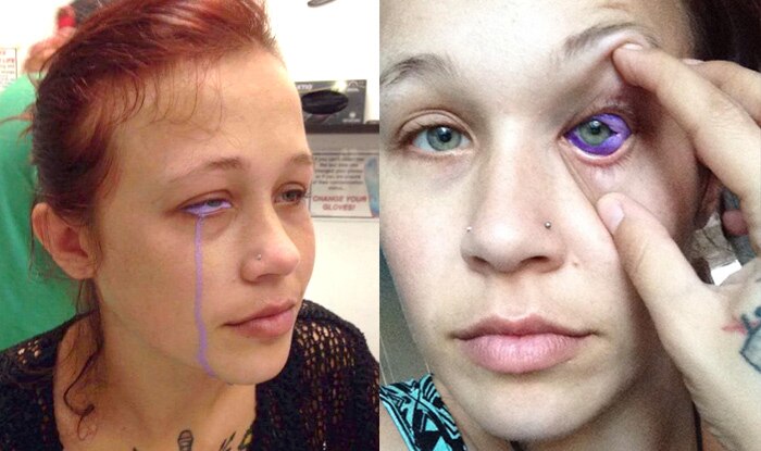 Eyeball Tattoo Leaves Model In Pain And Partially Blind