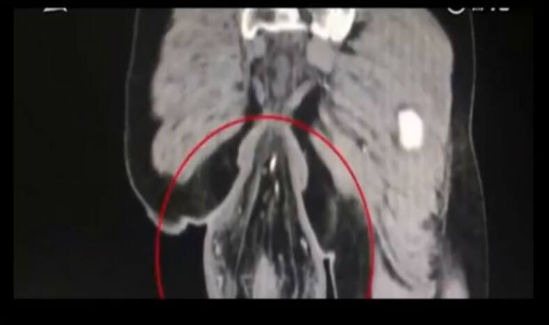 Chinese Mans Rectum Falls Out After He Spent Too Much Time Playing On