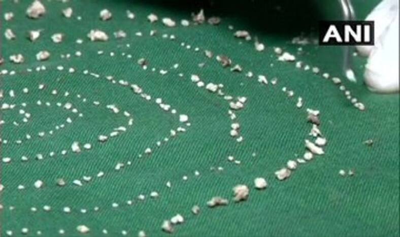 Chennai: In a First, Doctors Extract 526 Teeth From 7-year-old's Mouth