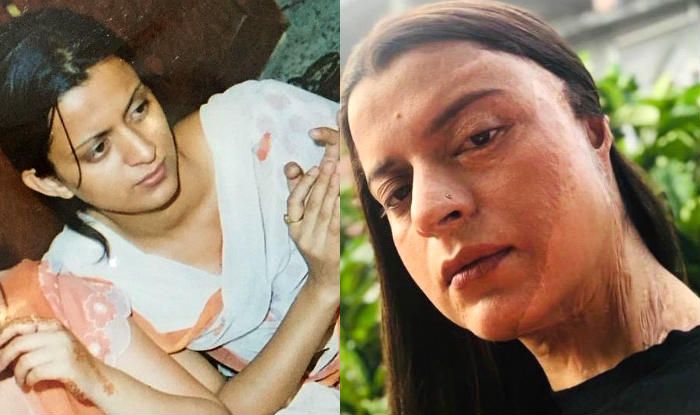 Rangoli Chandel Shares Her Acid Attack Survival Story in Heartbreaking ...