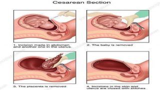 Common Myths Surrounding C-section Busted For You Common Myths Surrounding C-section Busted For You