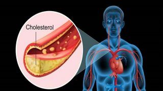 Here is Why You Must Maintain Balance Between Good And Bad Cholesterol Level Here is Why You Must Maintain Balance Between Good And Bad Cholesterol Level