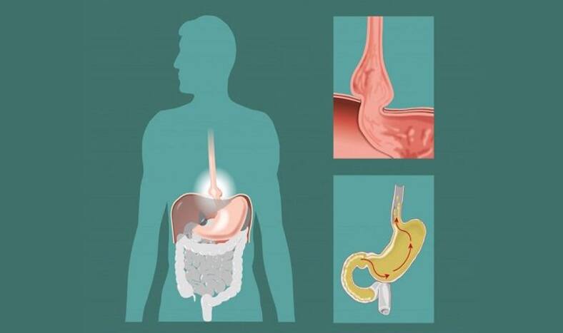 All You Need To Know About Gastroesophageal Reflux Disease 0783