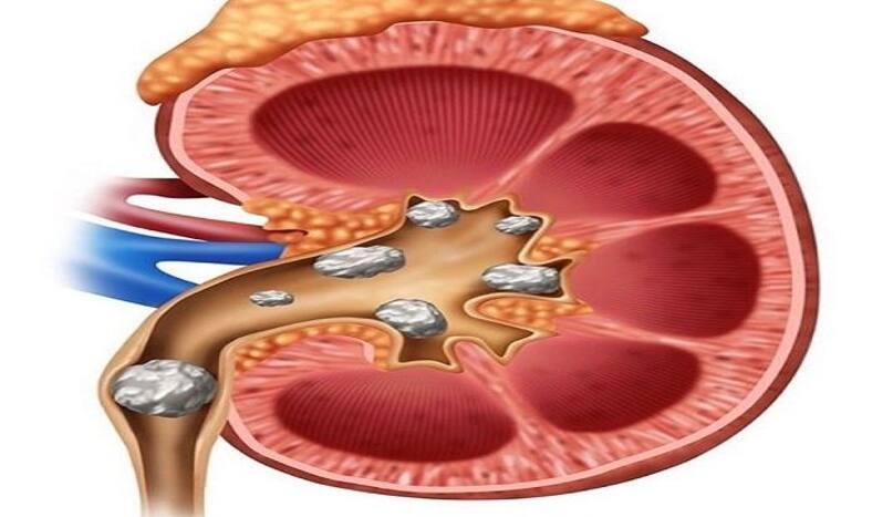 Natural Ways to Dissolve Kidney Stones