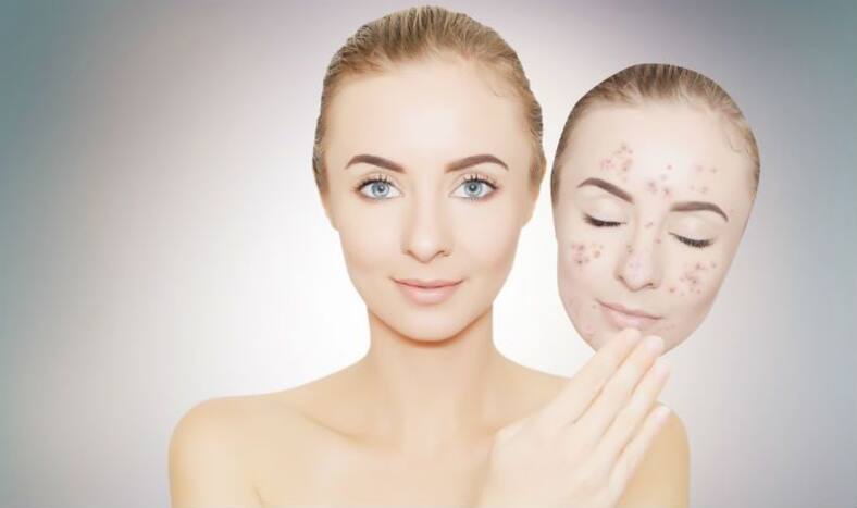 Want to Get Rid of Dark Spots? These Home Remedies May Help