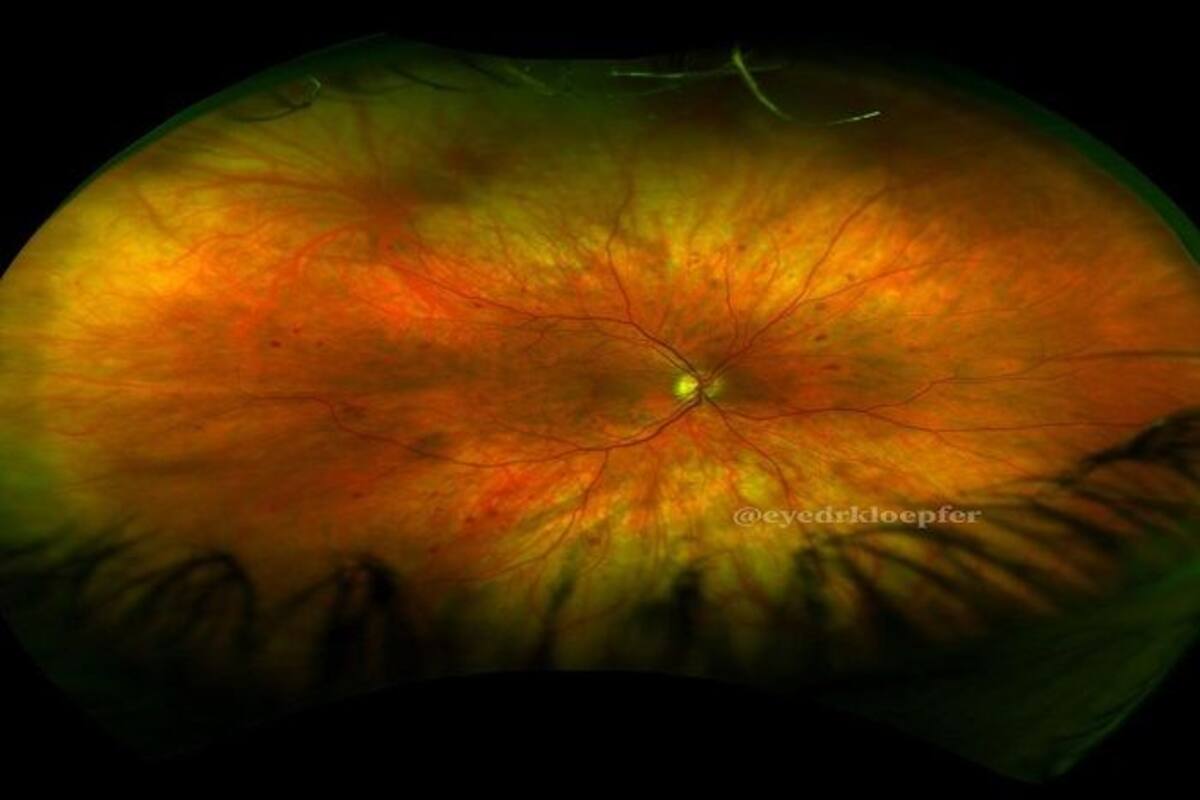 Diabetic Retinopathy These Herbs Can Heal The Condition Islamic matrimony fb page, dhaka, bangladesh. diabetic retinopathy these herbs can