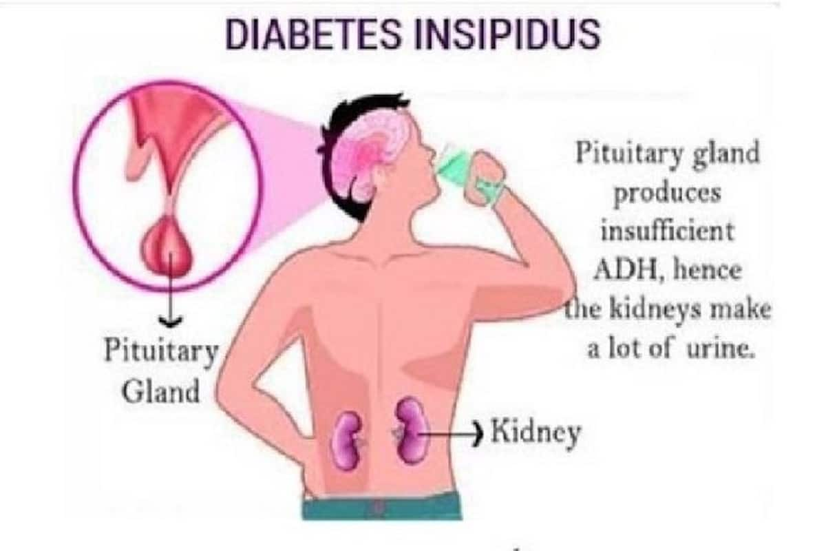 diabetes insipidus type 2)