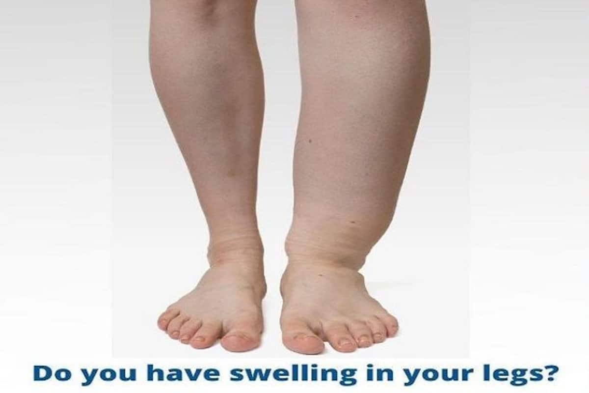 Diabetes Swollen Feet - Top of Foot Edema