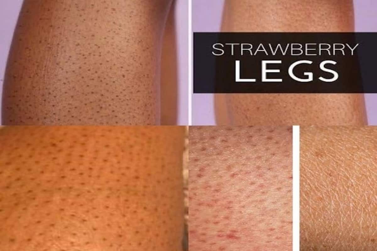 How To Remove Strawberry Legs Offer Cheap Save 62 Jlcatjgobmx