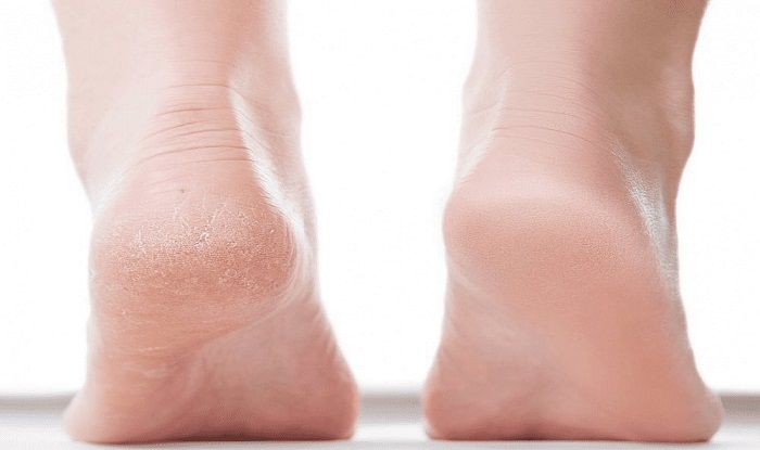 home remedies to get rid of cracked heels