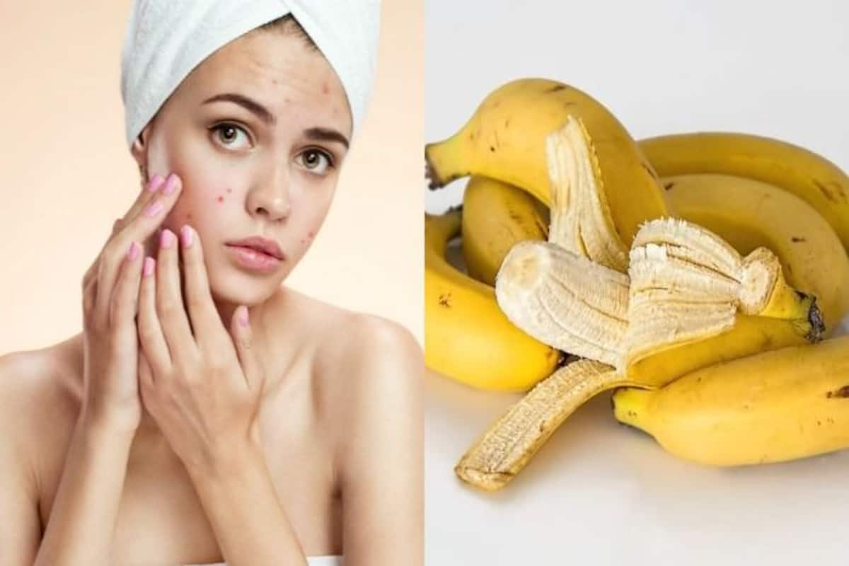 Banana Can Remove Acne How To Use Fruit Peel To Get Rid Of This Skin Problem Add water or yogurt to adjust the consistency. banana can remove acne how to use