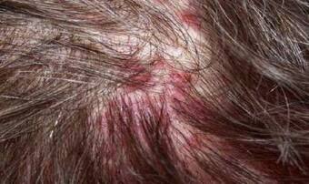 Beauty Tips: How to Get Rid of Pimples on The Scalp Beauty Tips: How to Get Rid of Pimples on The Scalp