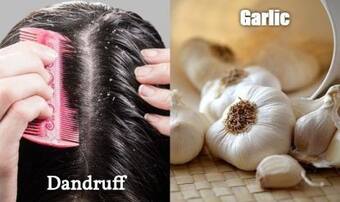 Dandruff And Garlic: What is The Link?
