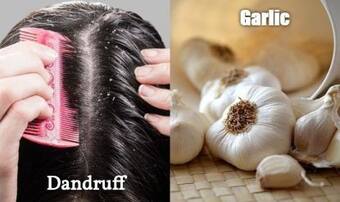 Dandruff And Garlic: What is The Link? Dandruff And Garlic: What is The Link?