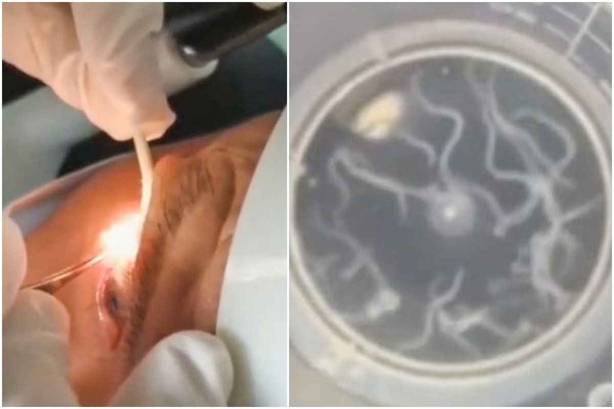 Yikes! Doctor Removes 20 Live Worms From 60-Year-Old Chinese Man’s Eyelid