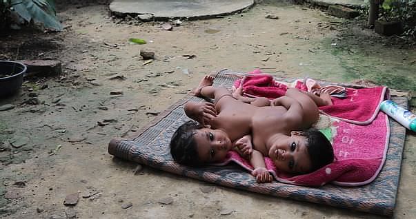 Remember Kushinagar's Conjoined Twins? They Have Finally Been Separated After 9-Hour-Surgery at Lucknow’s KGMU