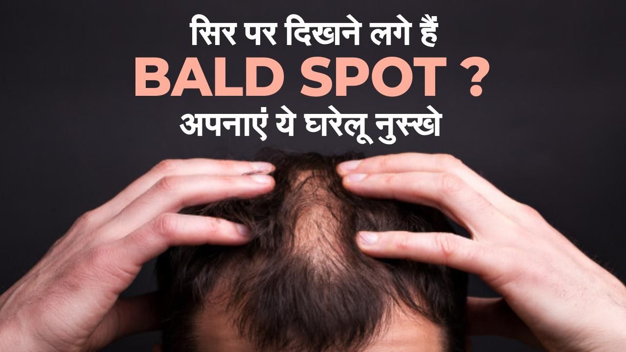 Baldness Home Remedies hair loss treatment causes protection Regrowing hair on a bald spot