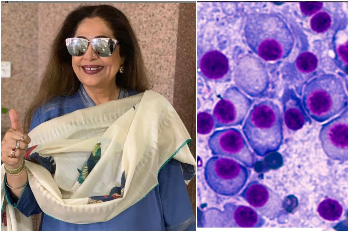 All About Multiple Myeloma, Type of Blood Cancer Kirron Kher is Suffering From